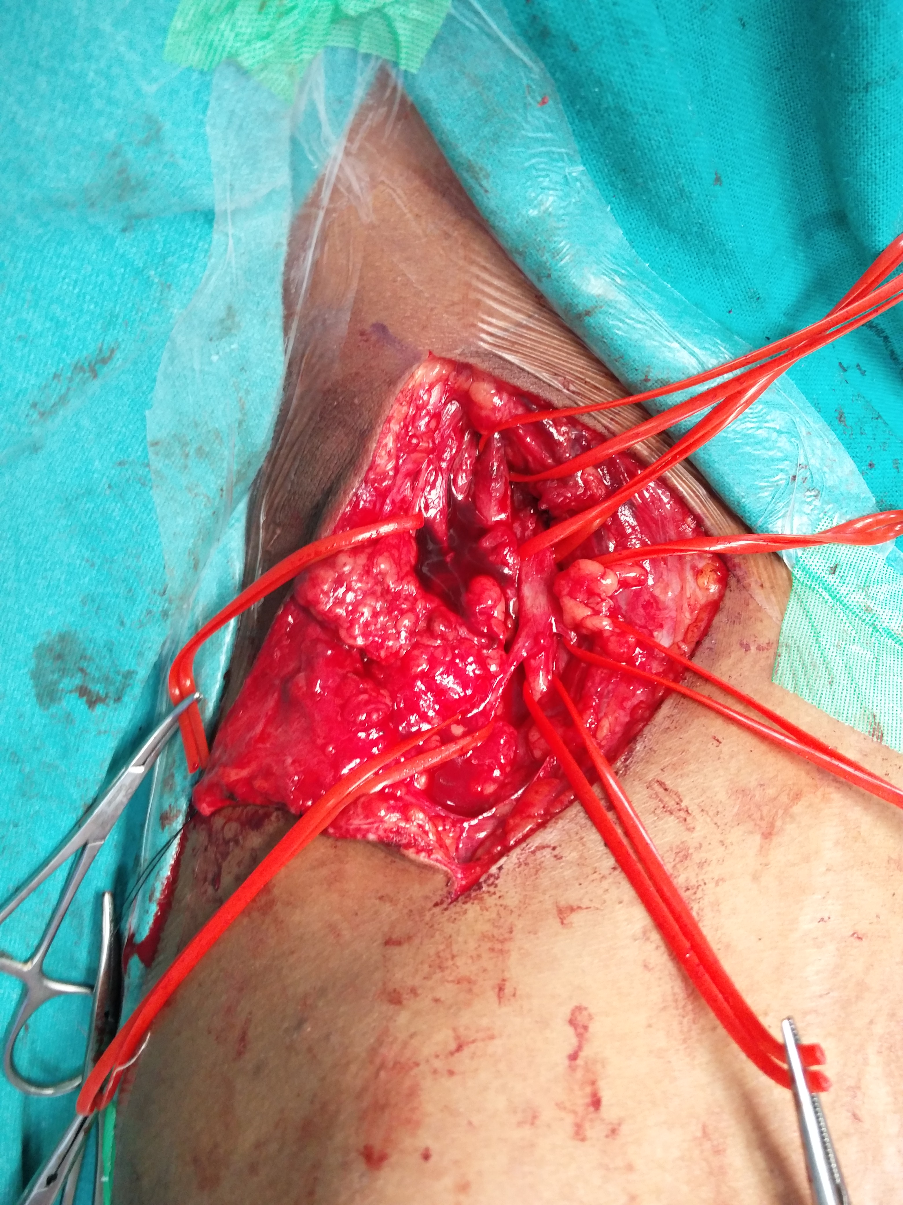 Brachial Plexus Surgery