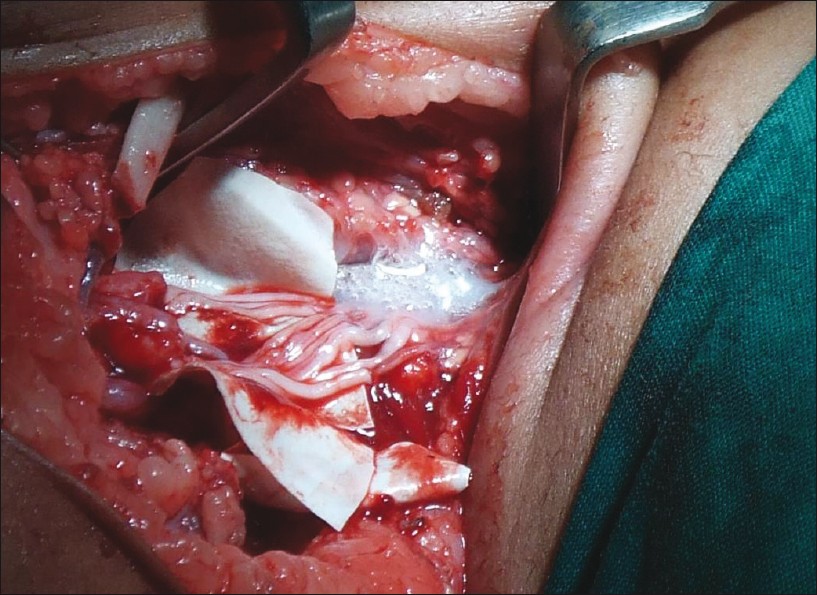 Brachial Plexus Surgery